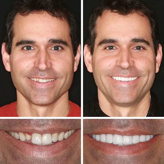 🏆Ends Today: 50% OFF! 🏆2026 Bestselling Product🦷 Fit for a Fresh Smile, Say Goodbye to Wearing Discomfort!🌎